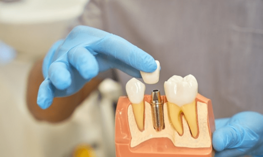 6 Reasons Why Dental Implants Are So Popular